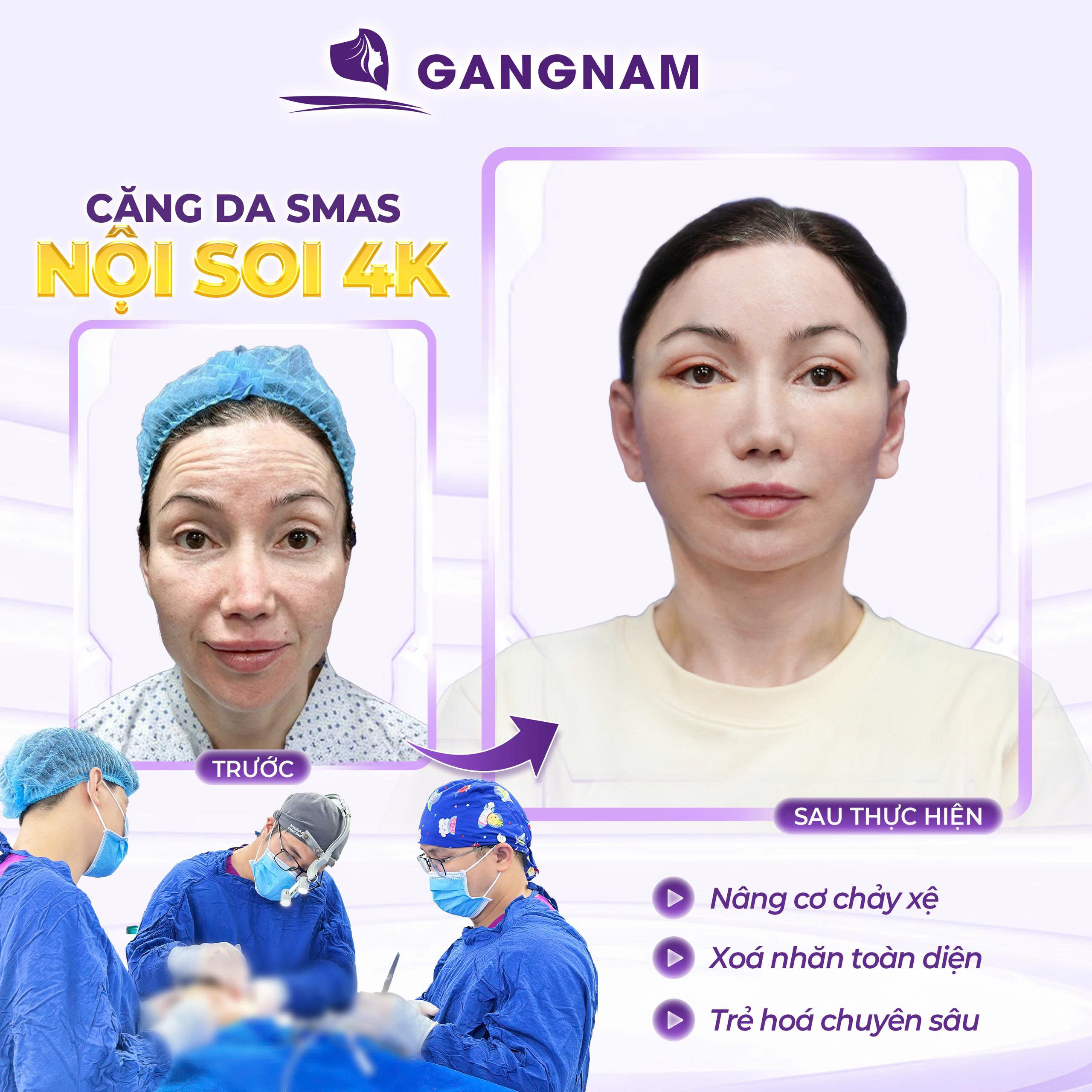 Căng da mặt bằng nội soi: Giải pháp trẻ hóa khuôn mặt hiệu quả 4 Căng da mặt bằng nội soi là gì?