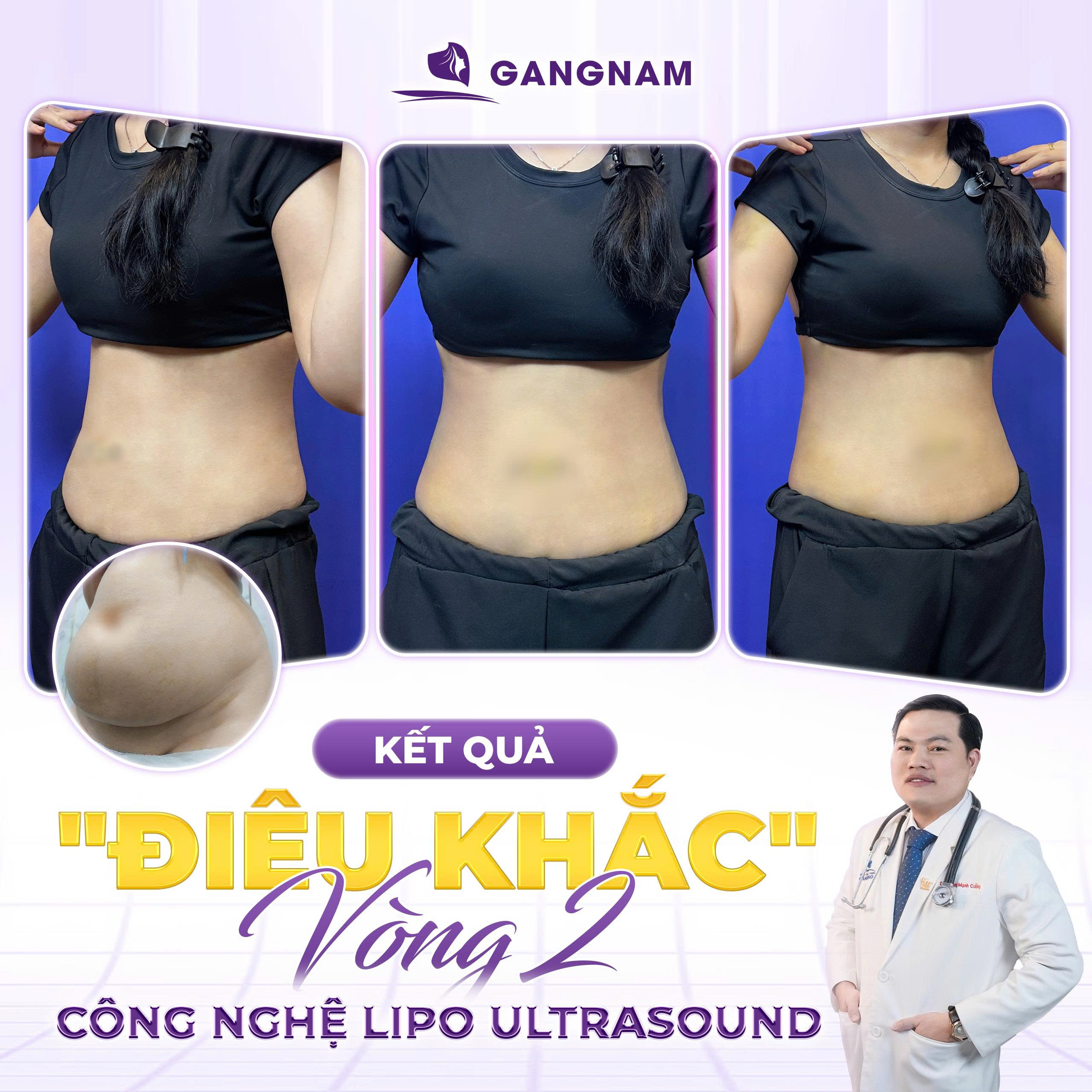 Giảm mỡ toàn thân Lipo: Giải pháp thẩm mỹ hiện đại cho vóc dáng hoàn hảo 5 Các vùng cơ thể phù hợp với giảm mỡ toàn thân Lipo