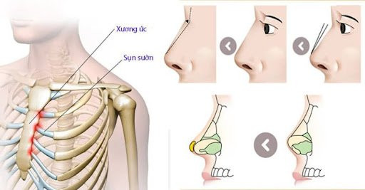 Nâng mũi sụn sườn tự thân là gì và tại sao nên chọn?