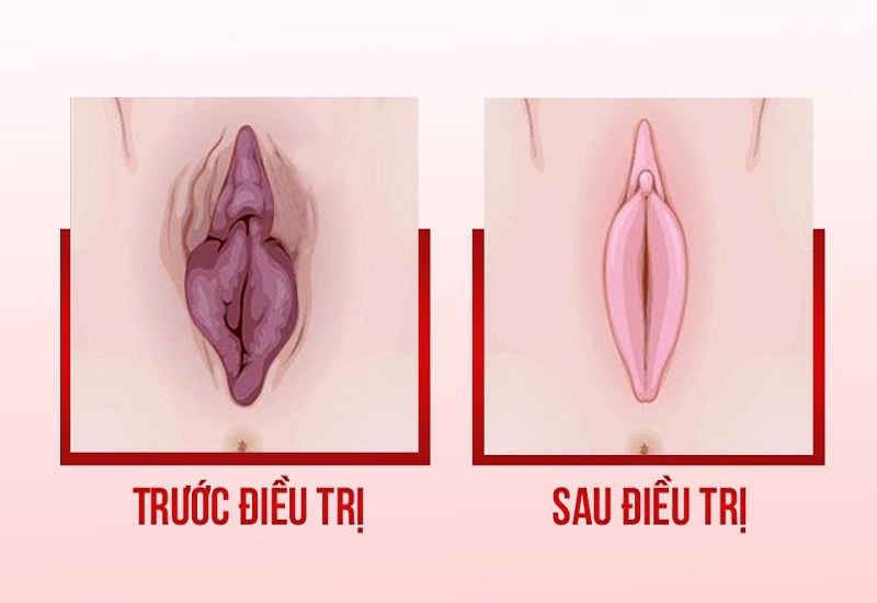 Đối tượng phù hợp với se khít vùng kín bằng HIFU