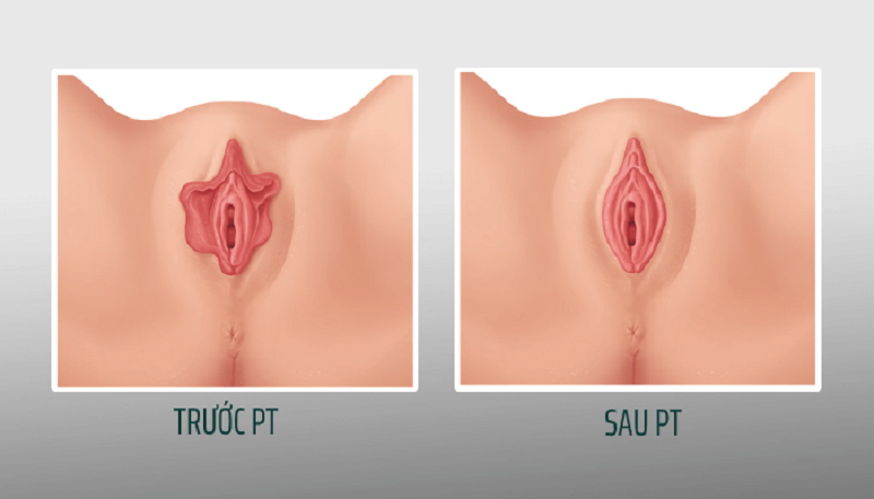 Thu gọn môi lớn vùng kín: Giải pháp thẩm mỹ an toàn và hiệu quả 4 Thu gọn môi lớn vùng kín là gì?