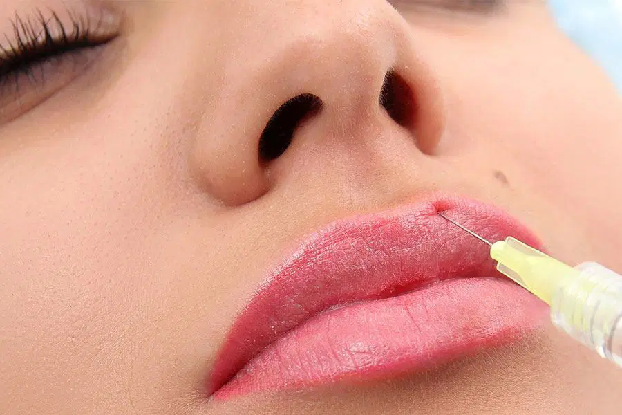 Làm đầy môi bằng filler là gì?