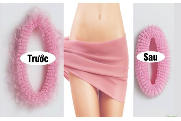 Đối tượng phù hợp với se khít âm đạo HIFU