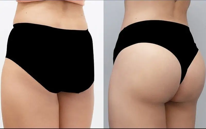 Cấy mỡ mông tự thân: Giải pháp nâng mông tự nhiên và an toàn 2