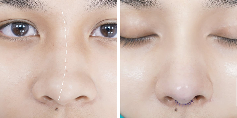 Lợi ích của việc chỉnh sửa mũi lệch
