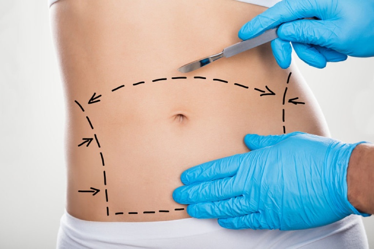Nâng cơ bụng nội soi (endoscopic abdominoplasty)