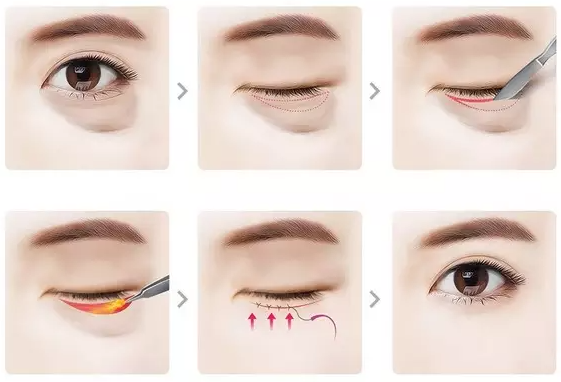 Lấy mỡ bọng mắt - Giải pháp trẻ hóa đôi mắt hiệu quả 4