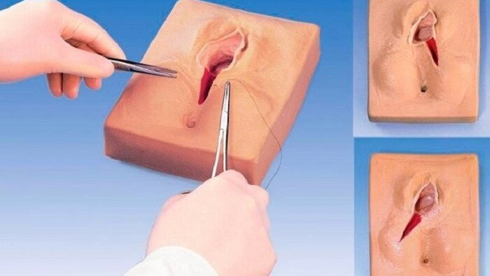 Se khít tầng sinh môn: Bí quyết lấy lại tuổi xuân vùng kín sau sinh 1