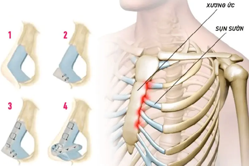 Nâng mũi sụn sườn nội soi là gì?