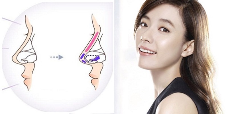 Phẫu thuật nâng mũi bọc sụn Nano: Giải pháp thẩm mỹ hiện đại cho dáng mũi hoàn hảo 4 Phẫu thuật nâng mũi bọc sụn Nano là gì?