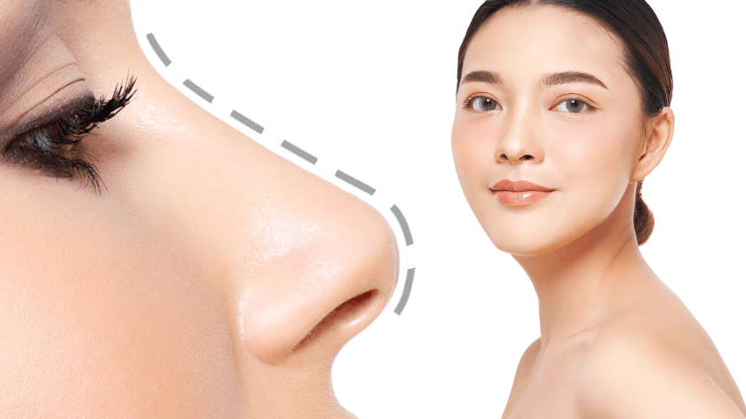 Nâng mũi siêu mềm Nanoform 4D: Giải pháp thẩm mỹ mũi hiện đại 2