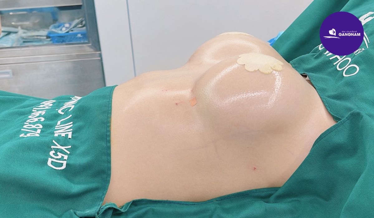 Nâng Ngực Túi ĐộN GSoft: Giải Pháp Hoàn Hảo Cho Vòng 1 Quyến Rũ 1