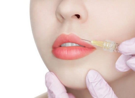 Tiêm filler môi quyến rũ là gì?