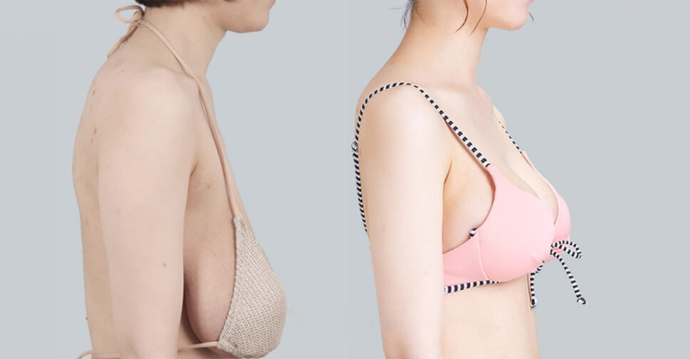 Treo ngực sa trễ bằng chỉ là gì?