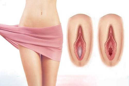 Tái tạo màng trinh là gì?