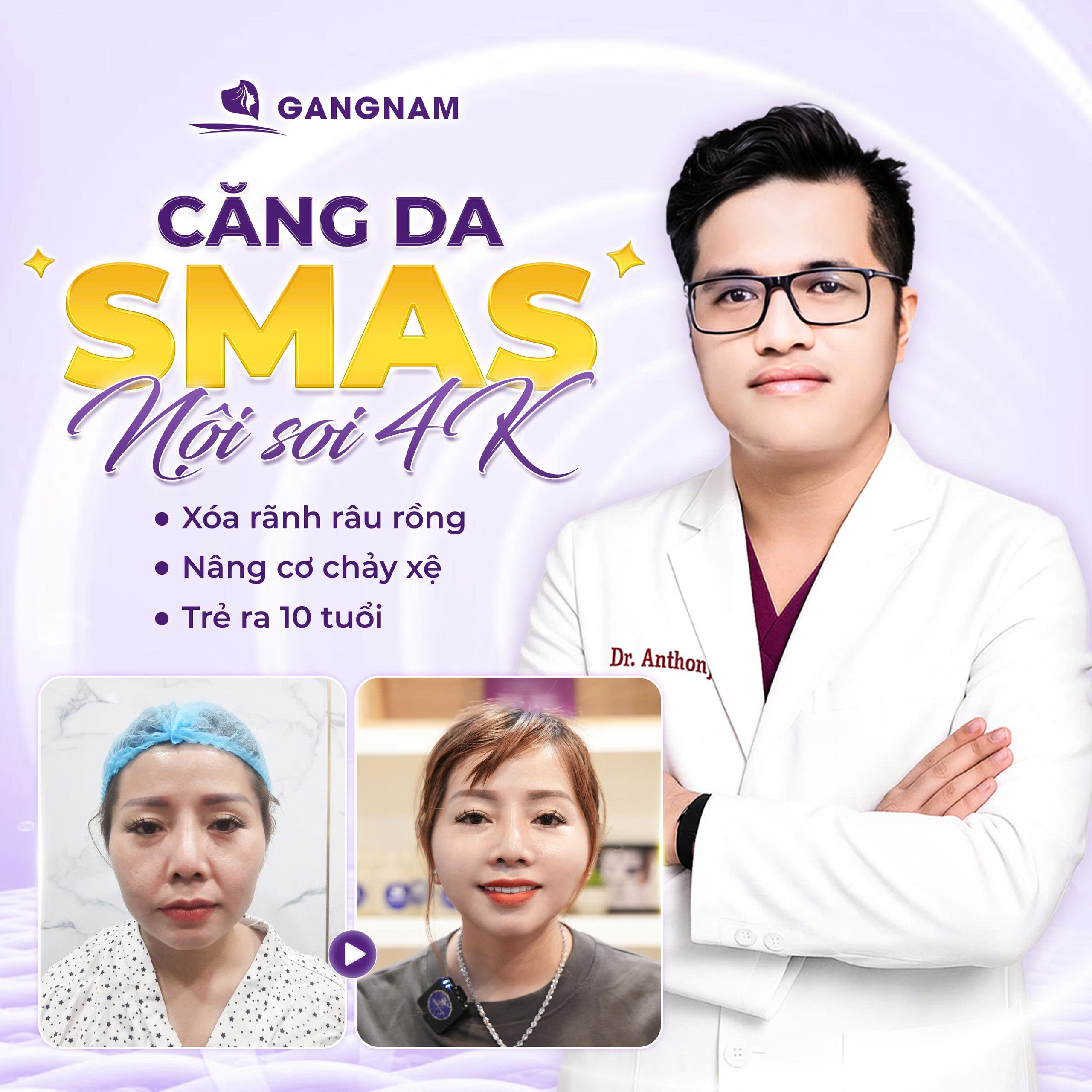 Căng da mặt SMAS 4K là gì?