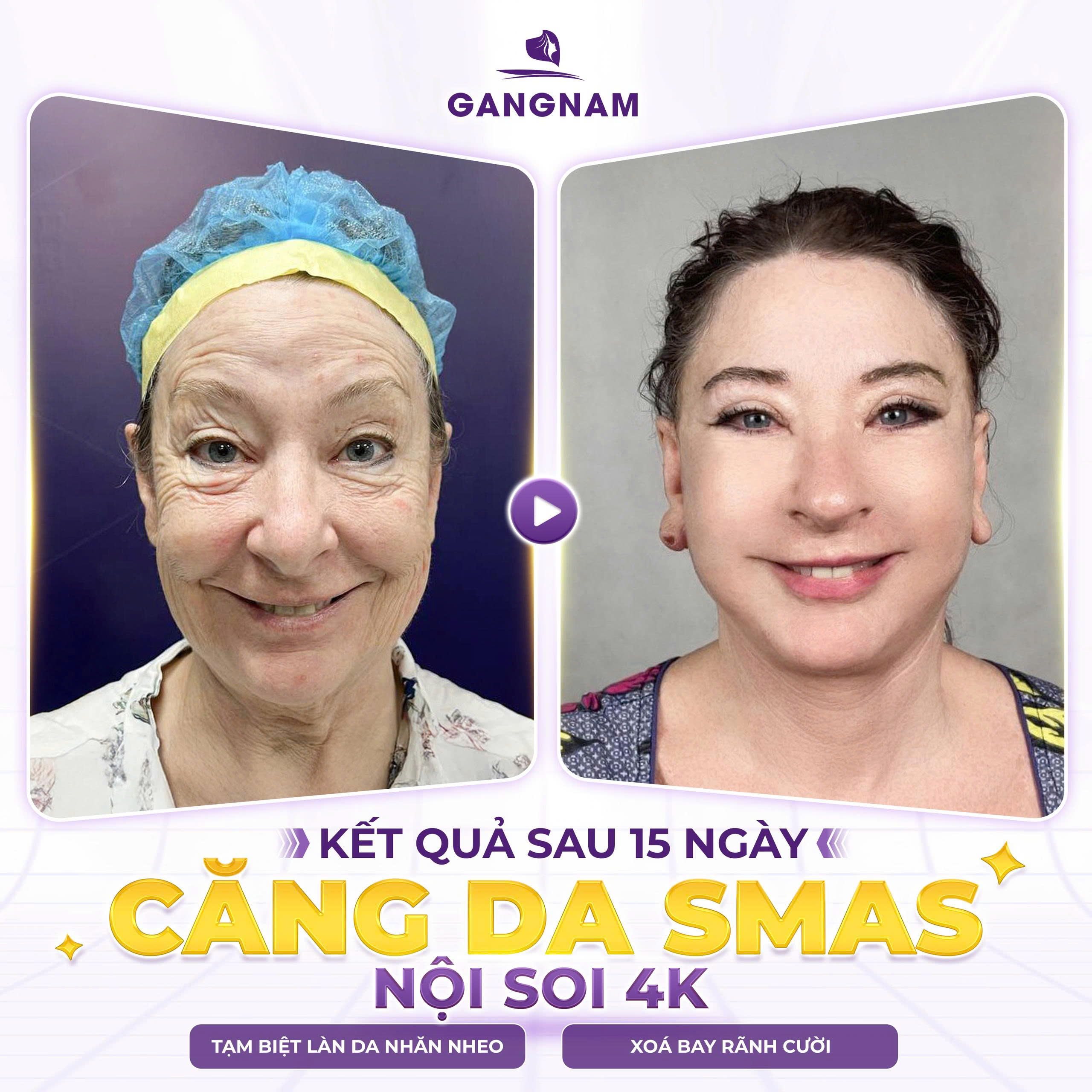 Căng da mặt nội soi 4K: Giải pháp trẻ hóa da hiện đại và hiệu quả 2