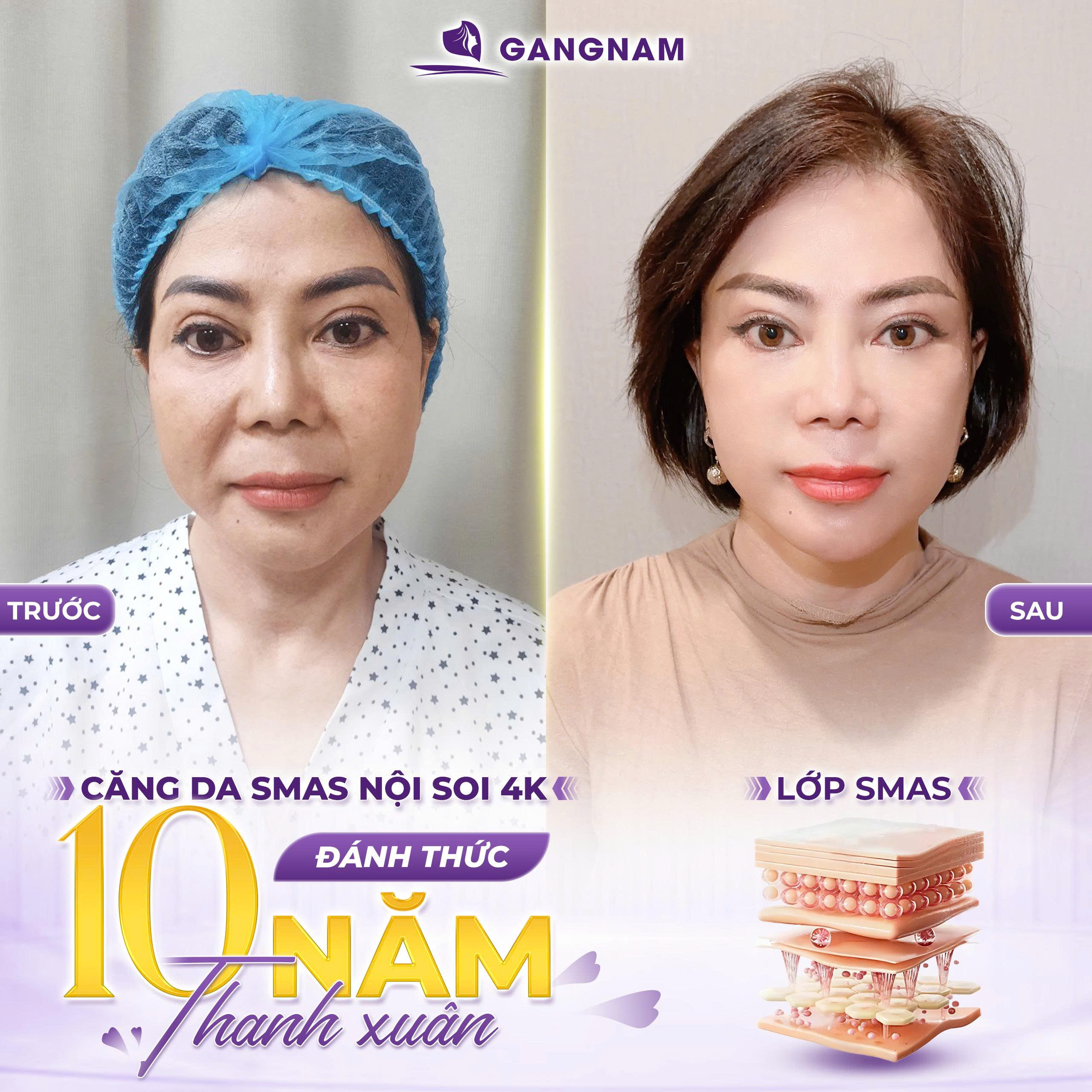 Lợi ích của căng da mặt SMAS 4K