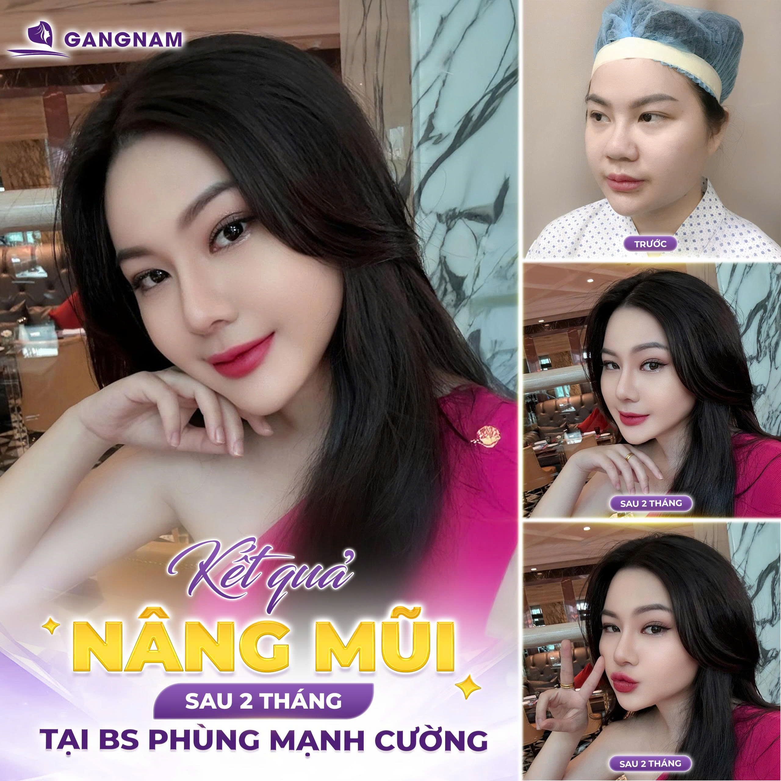 Tự tin với dáng mũi cân đối tại Thẩm mỹ Gangnam
