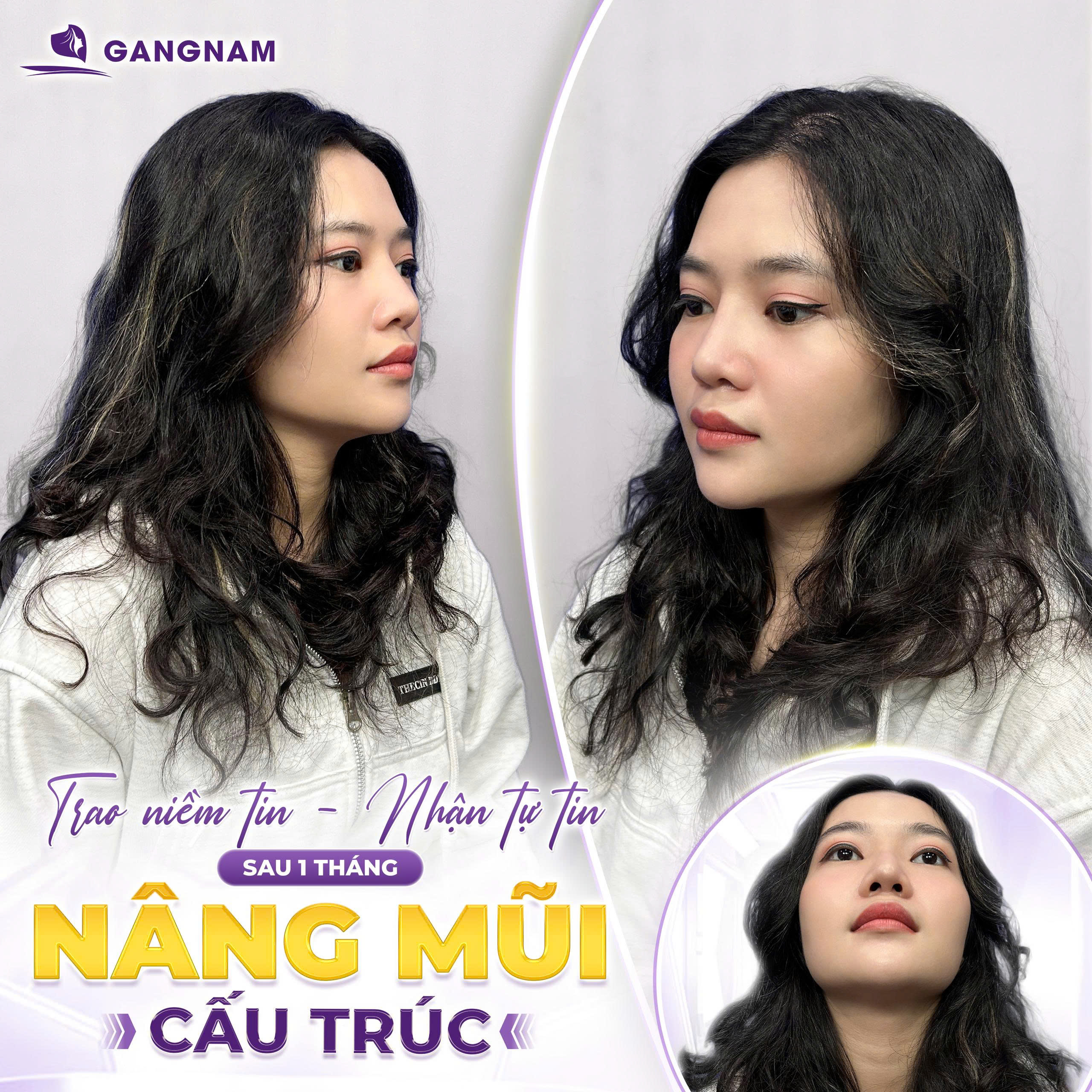 Nâng mũi bọc sụn Nanoform - Giải pháp thẩm mỹ mũi hiện đại 6 Nâng mũi bọc sụn Nanoform tại Gangnam