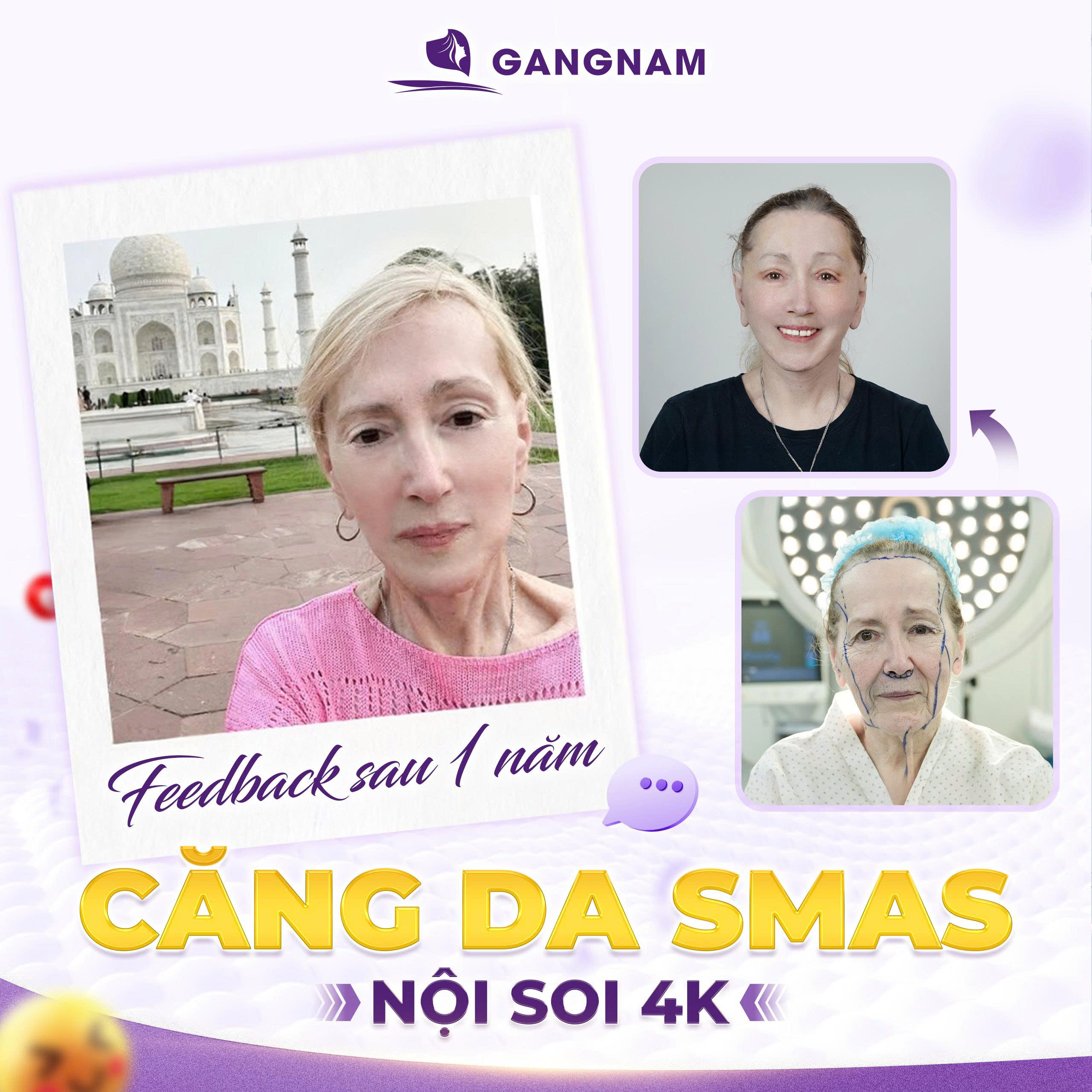 Căng da mặt có đau không? Giải đáp chi tiết cho bạn 4 Căng da mặt có đau không trong quá trình thực hiện?