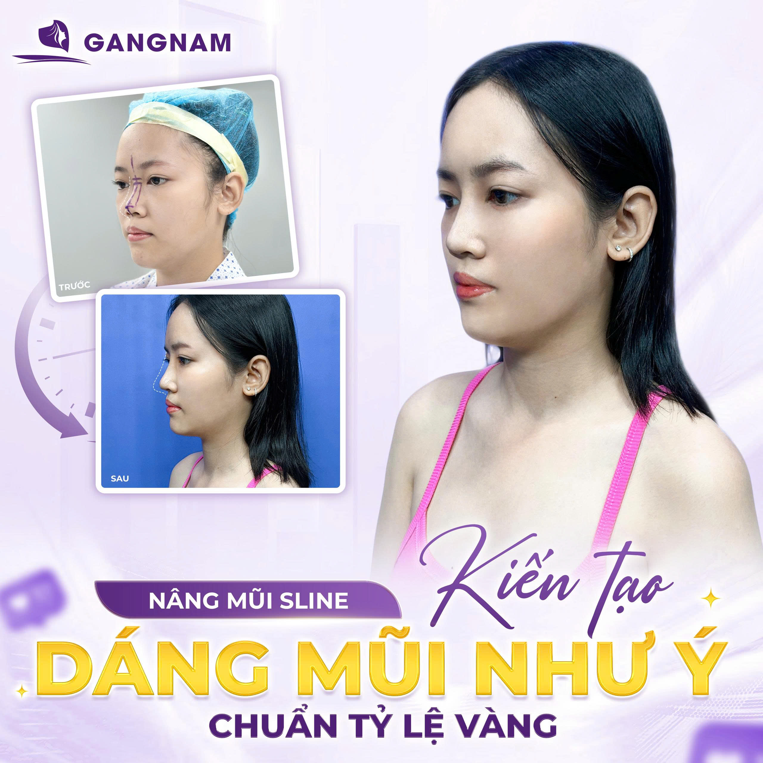 Nâng mũi sụn sườn tự thân – Giải pháp hoàn hảo cho dáng mũi thanh tú, tự nhiên 