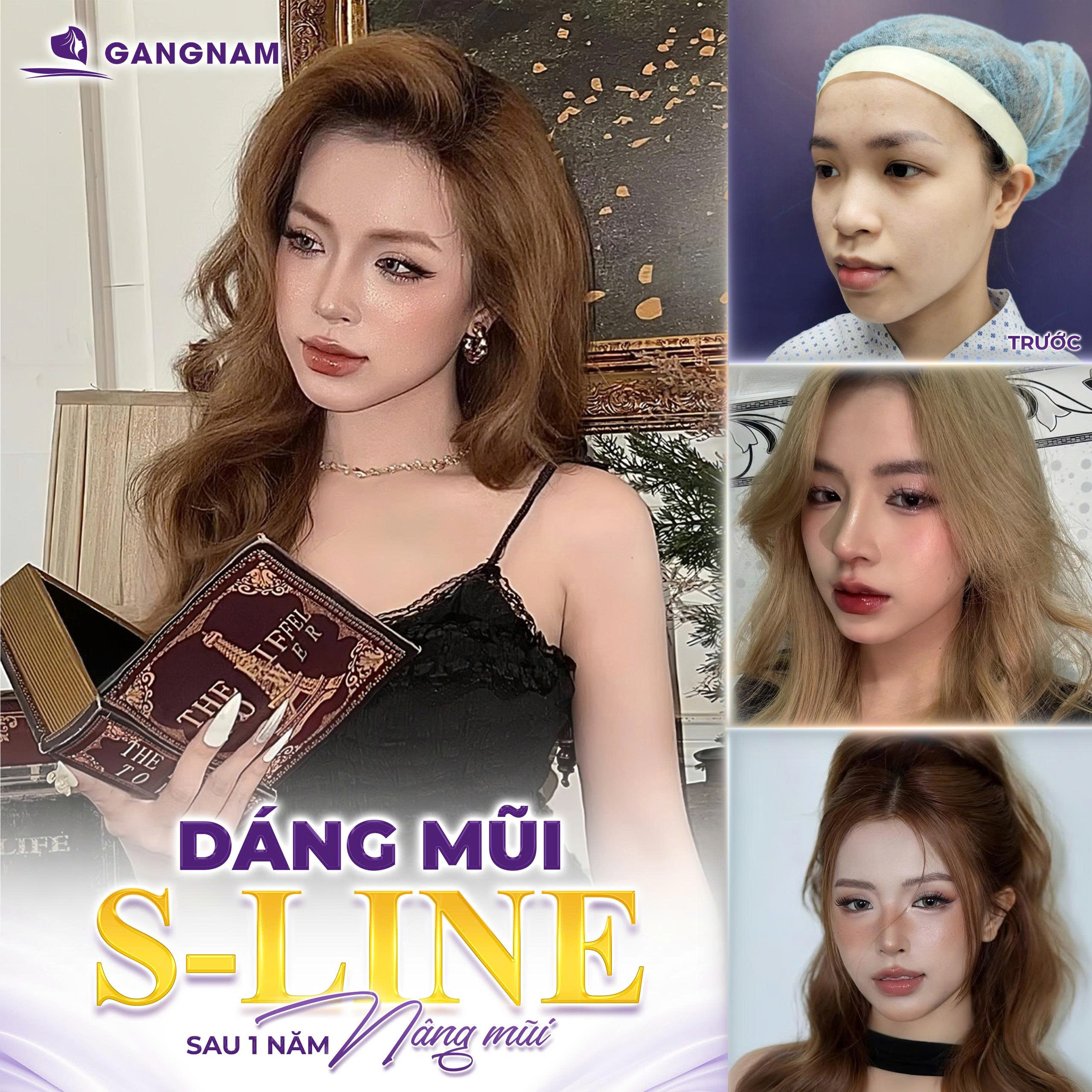 Nâng mũi Nanoform dáng tự nhiên tại Thẩm mỹ Gangnam