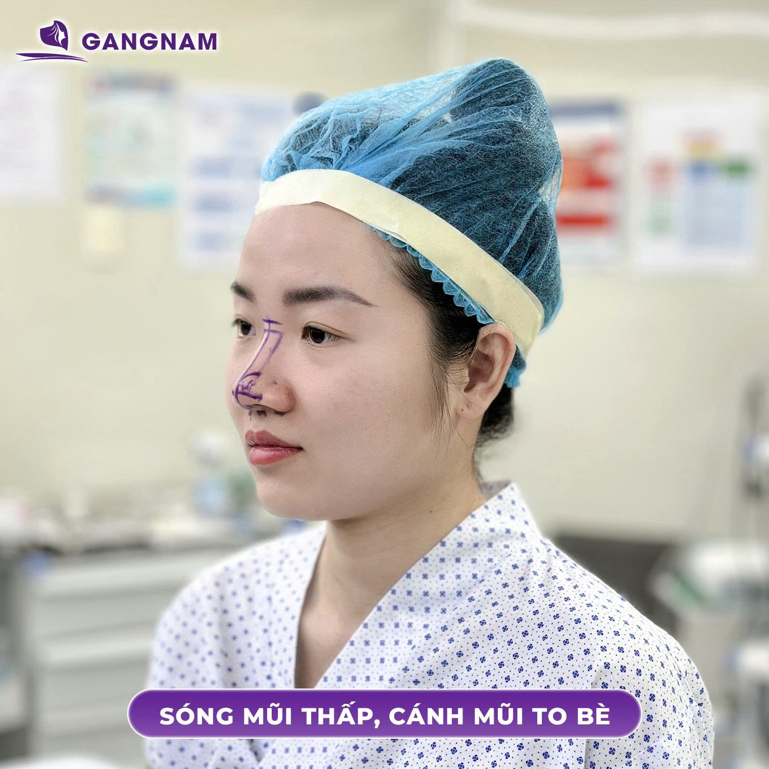 Nâng Mũi Nội Soi Sụn Sườn: Phương Pháp Tiên Tiến Cho Mũi Khó 5 Quy trình nâng mũi nội soi sụn sườn chuẩn y khoa