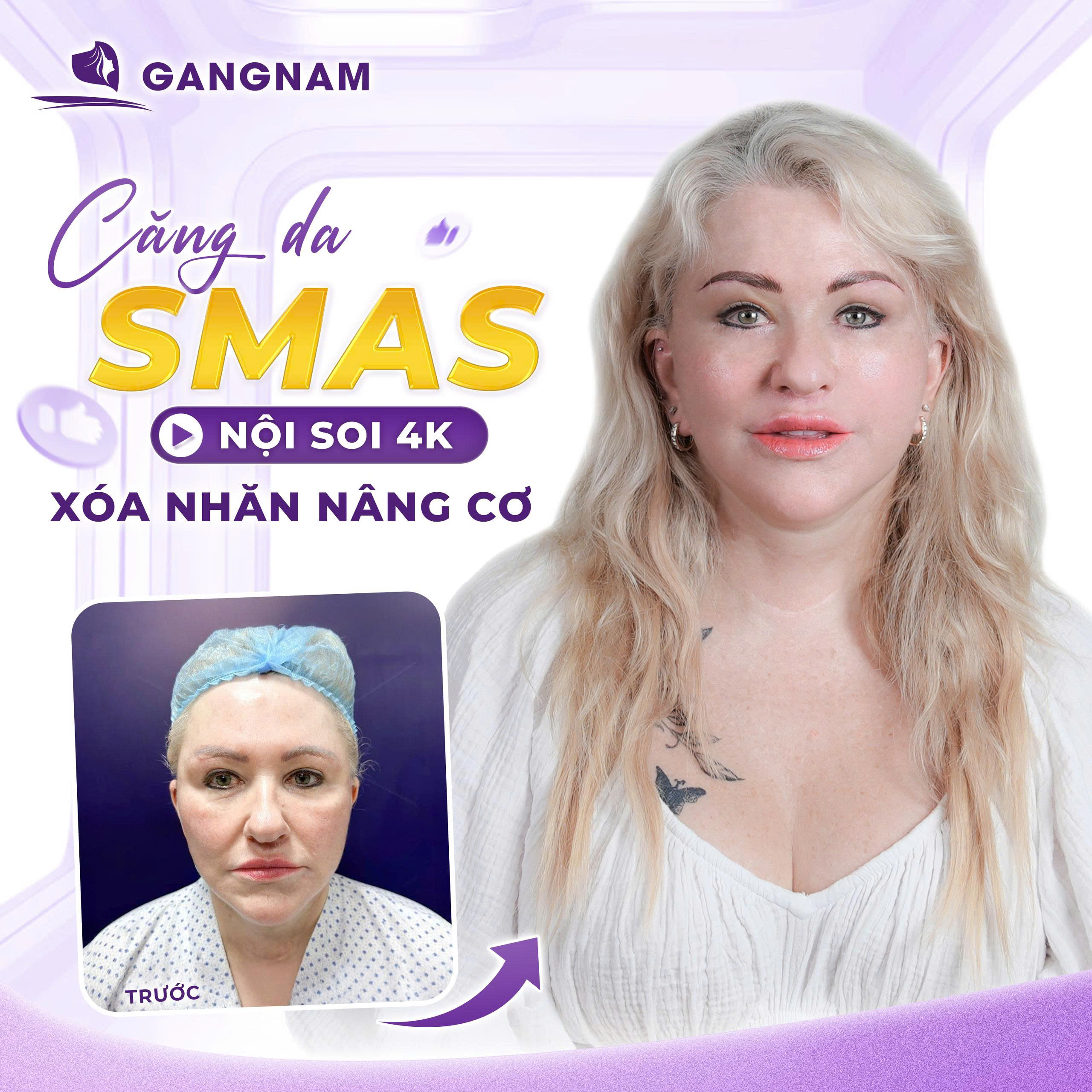 Căng da mặt công nghệ SMAS là gì và cơ chế hoạt động