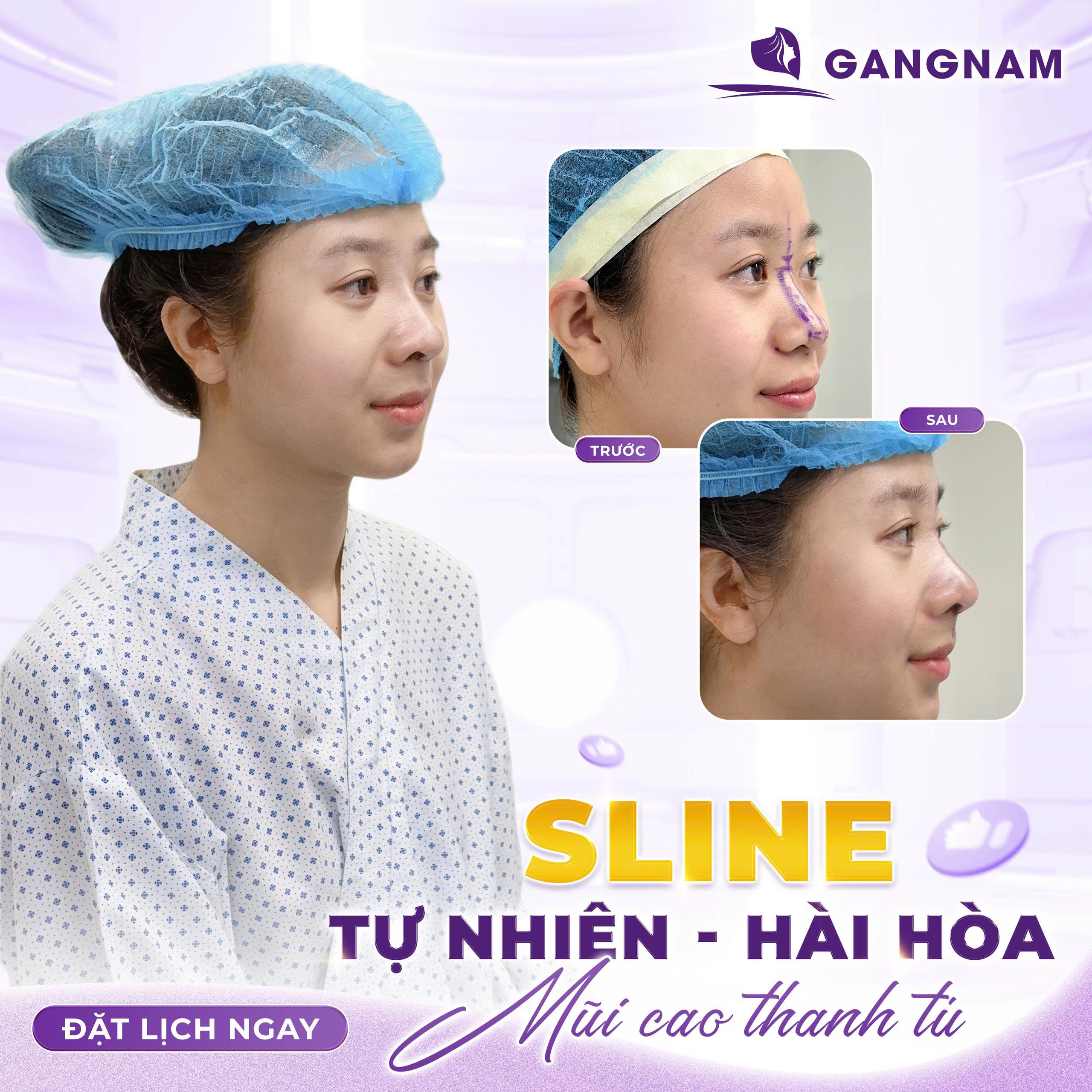 Phẫu thuật nâng mũi bọc sụn Nano: Giải pháp thẩm mỹ hiện đại cho dáng mũi hoàn hảo 6 Nâng mũi bọc sụn Nano – Giải pháp hoàn hảo cho dáng mũi cao đẹp tự nhiên