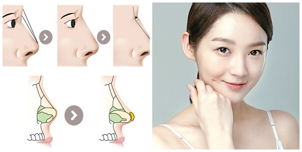 Nâng mũi Nanoform tự nhiên – Bí quyết sở hữu dáng mũi đẹp hoàn hảo 4 Nâng mũi Nanoform tự nhiên là gì?
