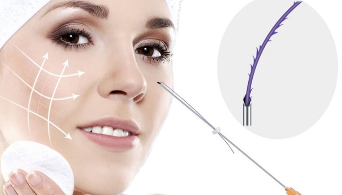 Căng da mặt bằng chỉ sinh học collagen: Bí quyết trẻ hóa không phẫu thuật 4 Căng da mặt bằng chỉ sinh học collagen là gì