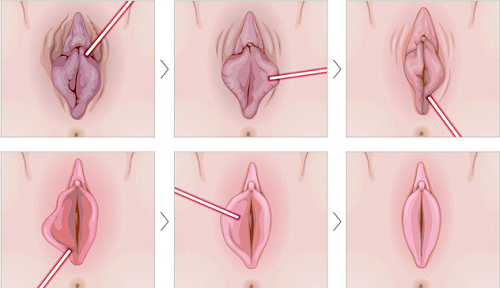 Cắt môi lớn đẹp tự nhiên: Bí quyết tái tạo vùng kín hài hòa và tự tin 4 Cắt môi lớn đẹp tự nhiên là gì?