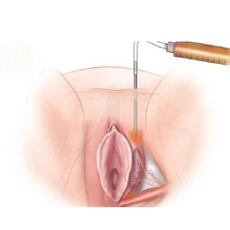 Cấy mỡ tự thân vùng mu – Bí quyết trẻ hóa “tam giác vàng” an toàn và tự nhiên nhất 4 Cấy mỡ tự thân vùng mu là gì?