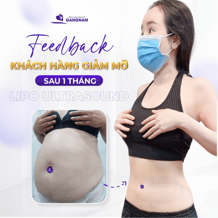 Hút mỡ tạo dáng eo nên chọn cơ sở nào uy tín?