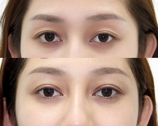 Bấm Mí Vĩnh Viễn Đẹp Tự Nhiên – Sở Hữu Đôi Mắt Hai Mí Hoàn Hảo 1