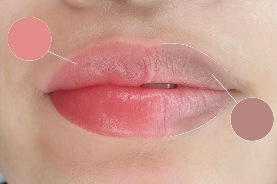 Khử thâm môi bằng laser là gì?