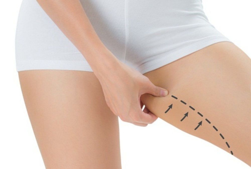 Hút Mỡ Bắp Đùi: Bí Quyết Sở Hữu Đôi Chân Thon Gọn, Cân Đối 1