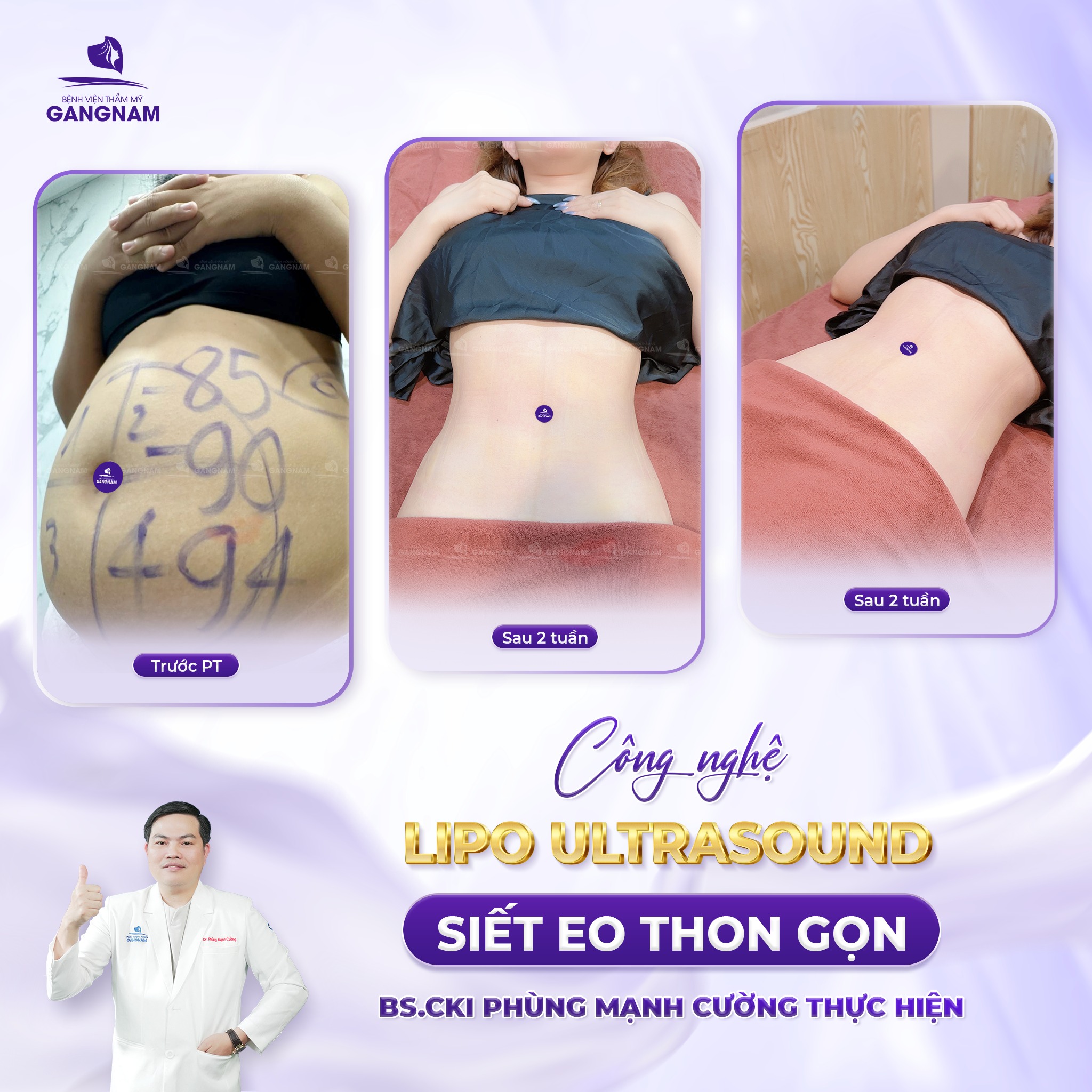 Hút mỡ tạo dáng eo – Bí quyết sở hữu vòng eo con kiến an toàn 2