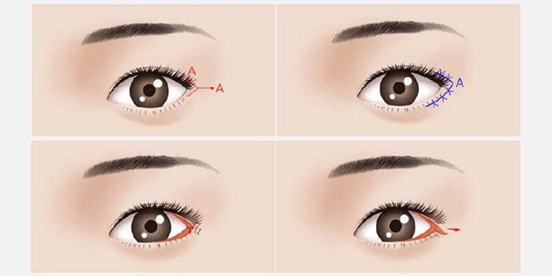 Mở góc mắt trong: Bí quyết sở hữu đôi mắt to tròn, cân đối tự nhiên 2