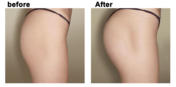 Nâng mông bằng mỡ tự thân Nano Fat: Bí quyết sở hữu vòng 3 hoàn hảo tự nhiên 5 Ai phù hợp với Nâng mông bằng mỡ tự thân Nano Fat và lưu ý quan trọng