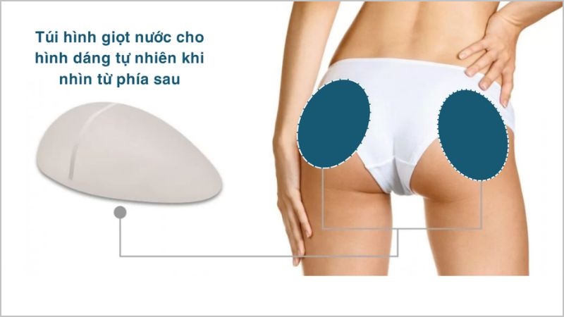 Nâng mông hình giọt nước – Bí quyết sở hữu vòng 3 quyến rũ tự nhiên 4 Nâng mông hình giọt nước khác gì so với nâng mông truyền thống?