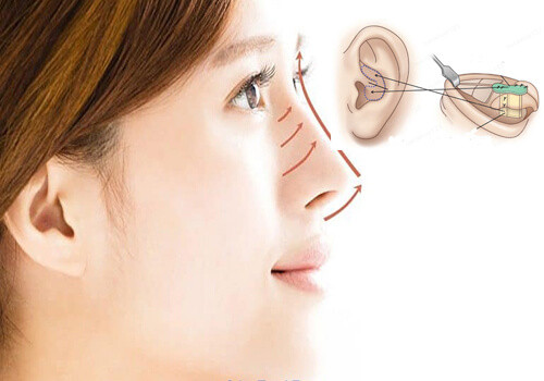 Nâng Mũi Cấu Trúc Sụn Vành Tai: Giải Pháp Toàn Diện Cho Dáng Mũi Hoàn Hảo 1