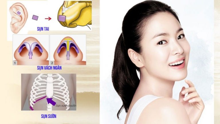 Nâng Mũi Bằng Sụn Tự Thân: Giải Pháp Hoàn Hảo Cho Dáng Mũi Tự Nhiên 4 Nâng Mũi Bằng Sụn Tự Thân Là Gì?
