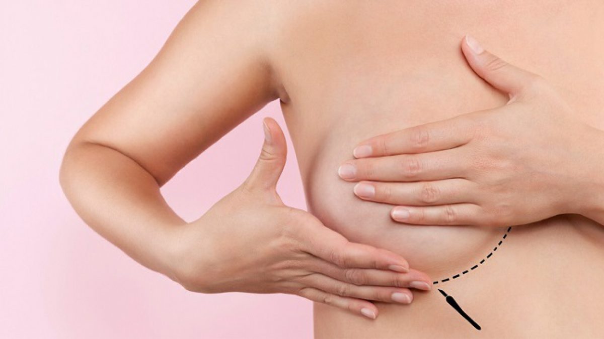 Nâng ngực nội soi 4K: Công nghệ thẩm mỹ ngực hiện đại nhất hiện nay 4 Nâng ngực nội soi 4K là gì?