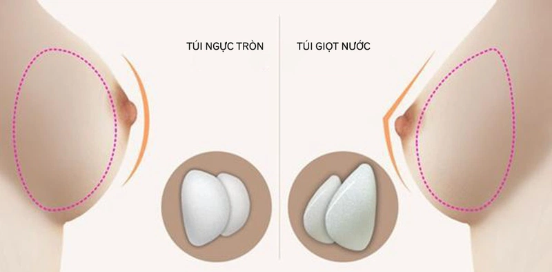 Phẫu thuật nâng ngực giọt nước: Bí quyết sở hữu vòng một tự nhiên hoàn hảo 4 Phẫu thuật nâng ngực giọt nước là gì?
