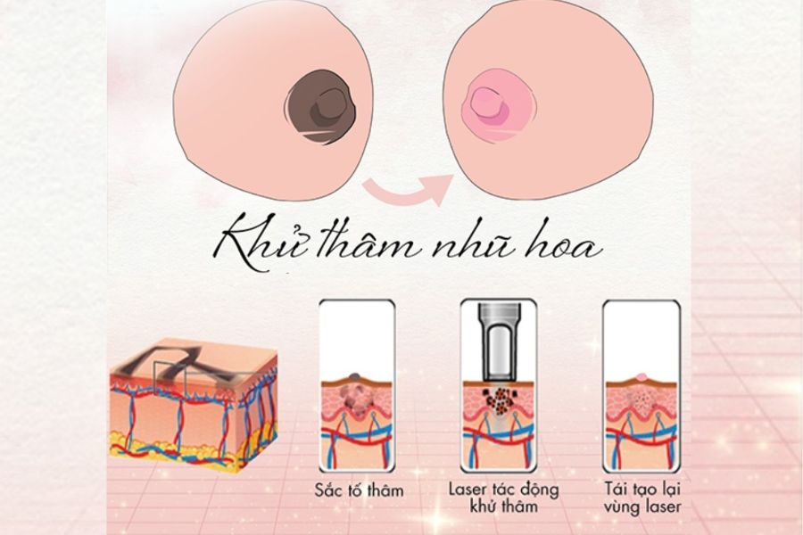 Làm Hồng Nhũ Hoa Bằng Laser: Bí Quyết Sở Hữu Vùng Kín Hoàn Hảo 4 Làm Hồng Nhũ Hoa Bằng Laser Là Gì ?