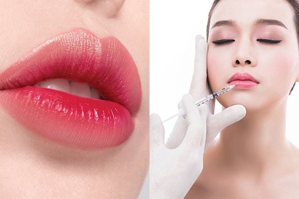 Tiêu chí vàng để đảm bảo tiêm filler môi an toàn