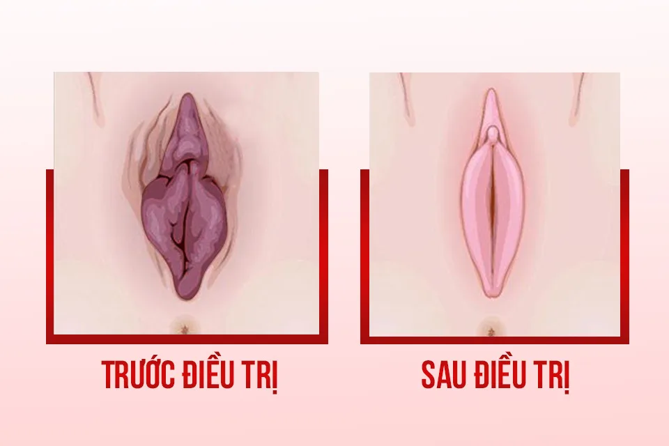 Làm hồng môi bé: Bí quyết sở hữu vùng kín hồng hào tự nhiên và an toàn 4 Làm hồng môi bé là gì?