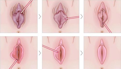 Thu gọn môi bé: Giải pháp thẩm mỹ vùng kín hiện đại và an toàn 4 Lý do nhiều phụ nữ chọn thu gọn môi bé